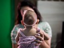 Comissão ajuda formalizar Associação de Microcefalia e outras Malformações por Zika Vírus Comissão ajuda formalizar Associação de Microcefalia e outras Malformações por Zika Vírus